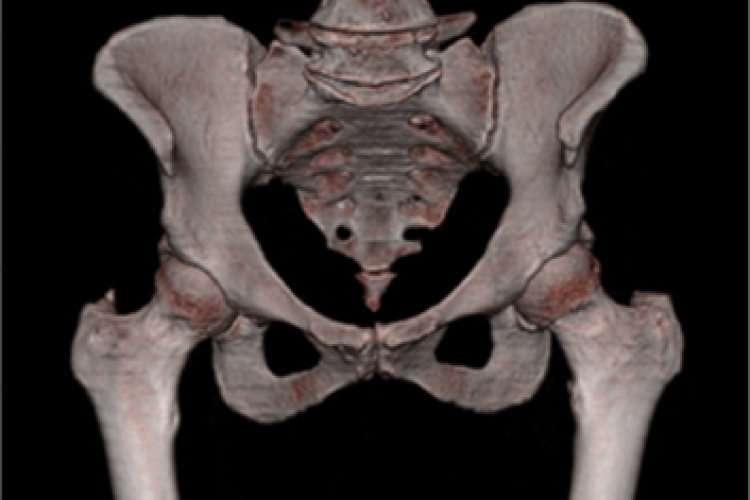 Imagen 3D anterior pelvis