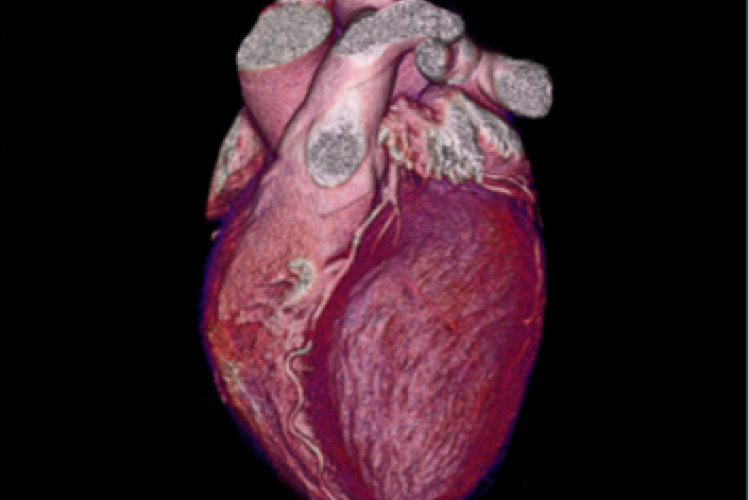 Visión 3D anterior izquierda de las arterias coronarias