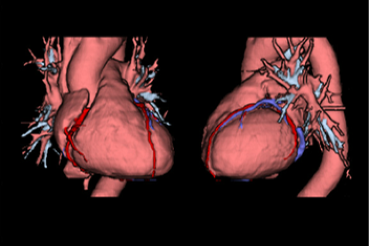 Vision corazón y coronarias 3D