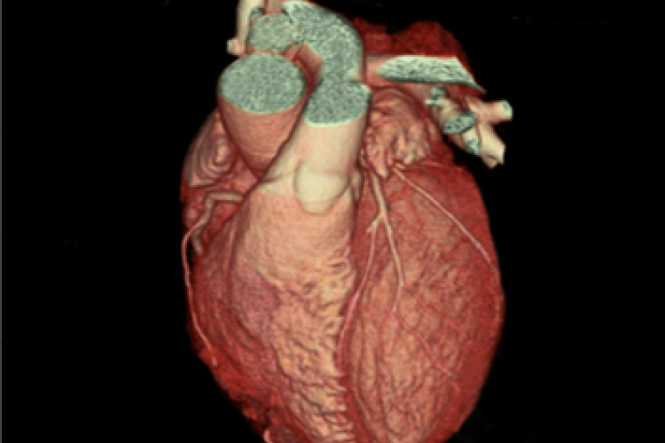 Visión anterior 3D Arterias coranarias