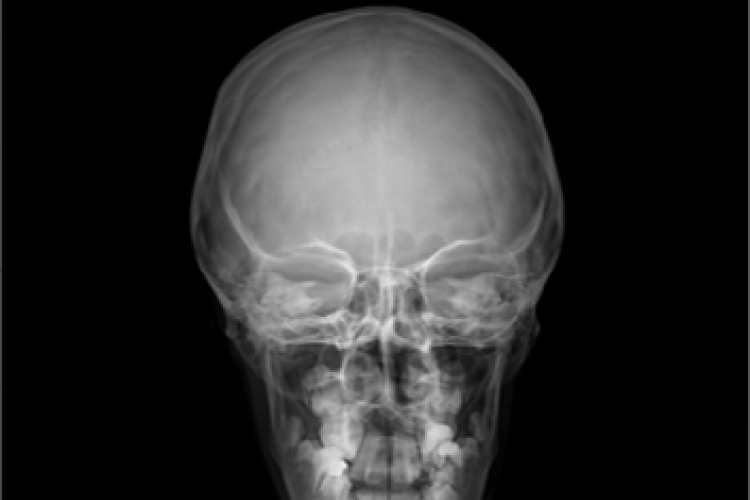 Imagen RX anterior posterior cráneo