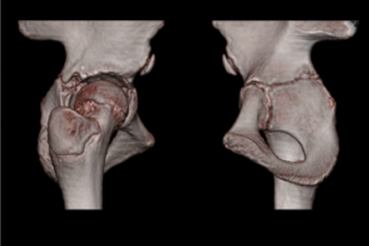 Visión lateral medial cadera 3D 