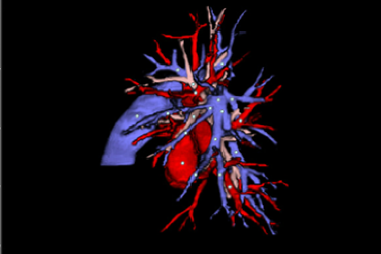vision lateral izquierda 3D TC vasos pulmonares