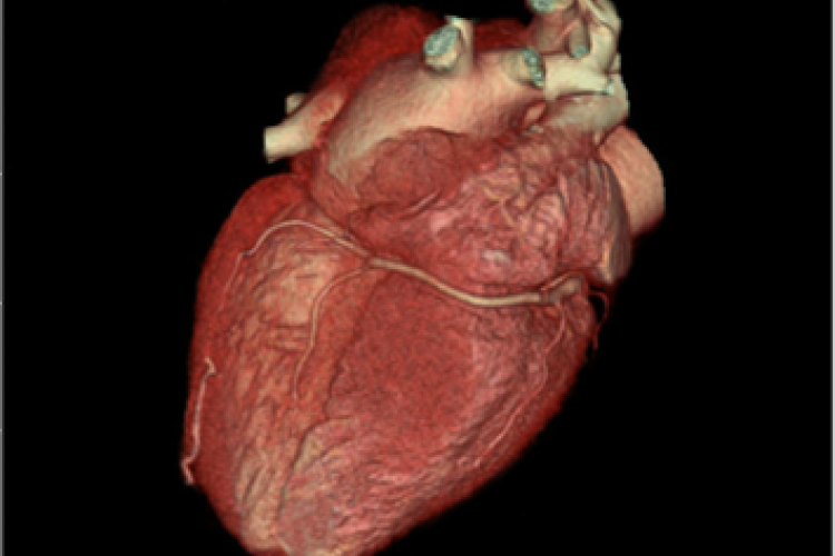 Visión posterior 3D corazón arterias coronarias