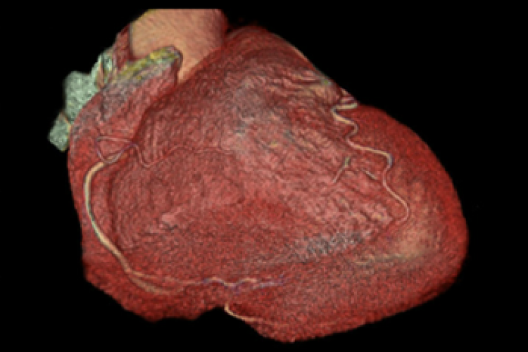 Visión anterior caudal 3D arterias coronarias corazón 