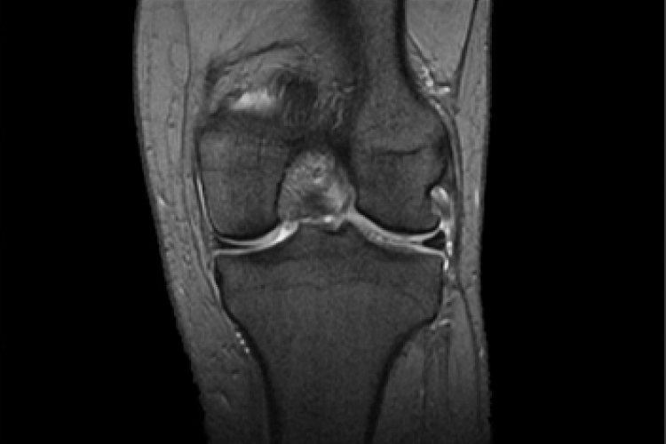 Imagen RX anterior posterior rodilla toma coronal
