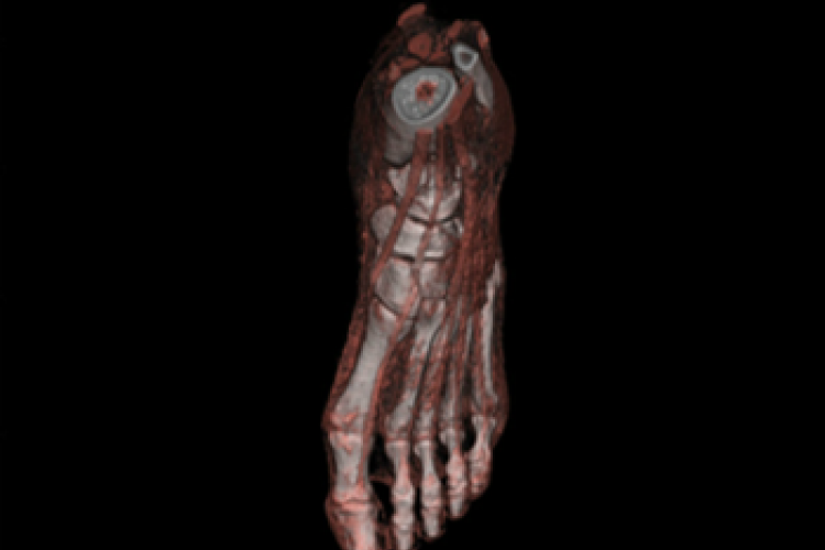 Visión dorsal 3D partes blandas del pie