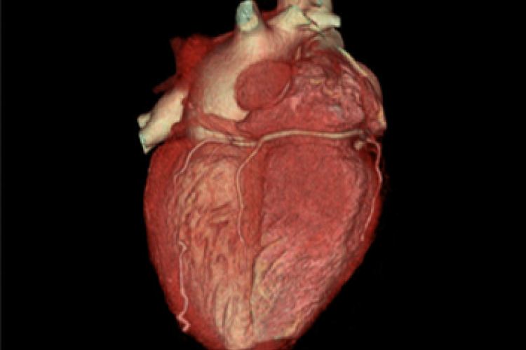 Visión posterior 3D corazón arterias coronarias
