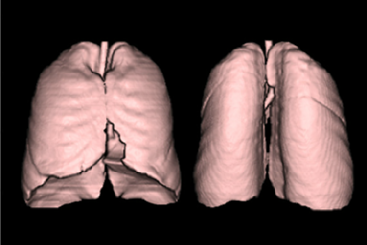Visión segmentos pulmonares 3D izquierdo y derecho