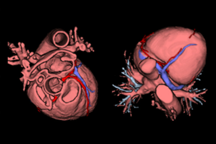 Vision craneal y caudal 3D corazón y coronarias