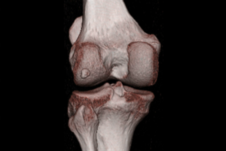 Posterior vision 3D knee
